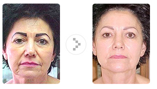 Non Surgical Face Lift 